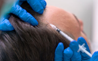 Mesoterapia capilar: la solución definitiva para frenar la caída y recuperar densidad capilar